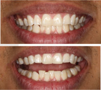 Invisalign Gallery