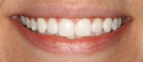 Invisalign Patient Photos